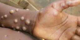 Africa CDC Declares Monkeypox Outbreak A Public Health Emergency