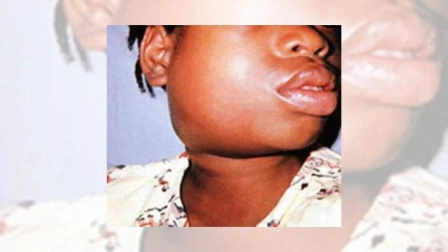 Bulawayo Sees Surge In Mumps Cases